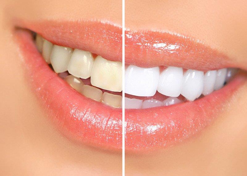 טיפול הלבנת שיניים